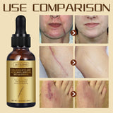 Fade Cesarean Scar Smooth Impression Repair Essential Oil